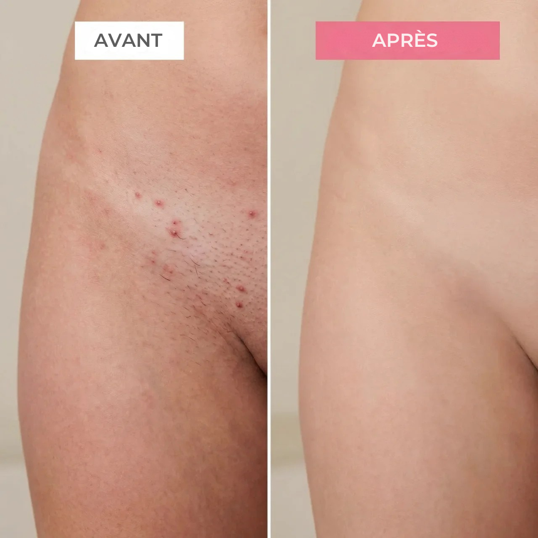 Helvano | Elektrischer Rasierer für empfindliche Zonen