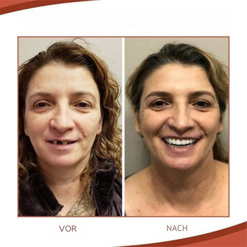 Helvano | Herausnehmbare Zahnprothese mit Naturzähnen