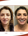 Helvano | Herausnehmbare Zahnprothese mit Naturzähnen